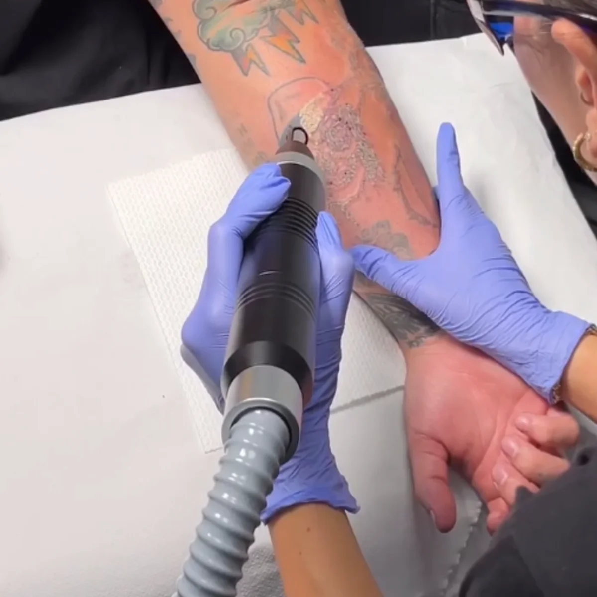 Melbourne Tattoo Removal